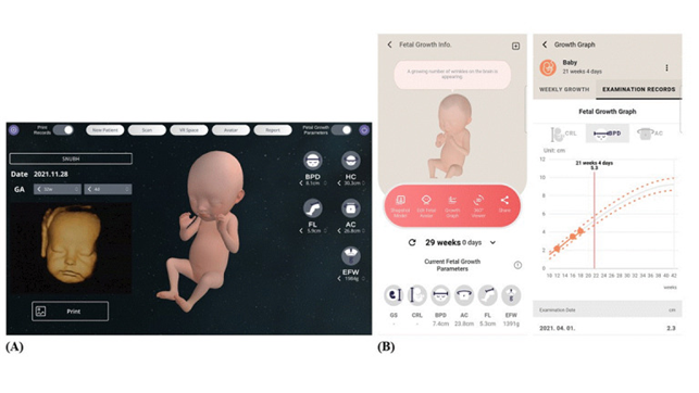 분당서울대병원은 VR 태아영상이 산모와 태아의 유대감과 우울감에 미치는 영향에 대해 발표했다. 사진은 초음파를 기반으로 가상현실에서 생성된 태아의 모습(왼쪽)과 초음파에서 변환된 데이터와 태아의 성장 보여주는 그래프(오른쪽). 분당서울대병원 제공