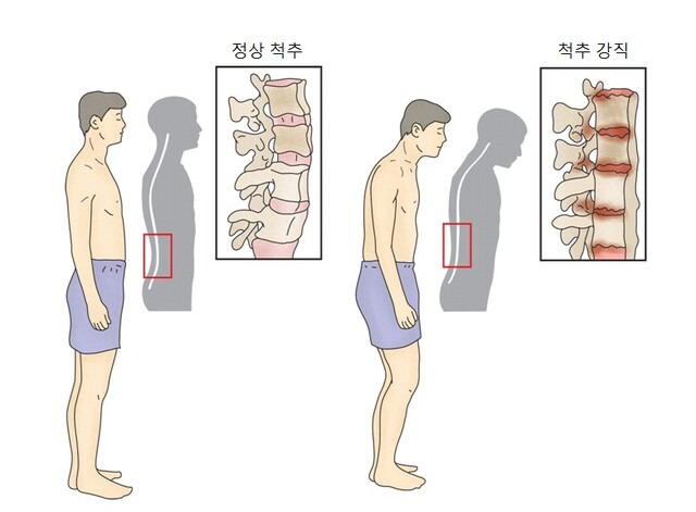 강직성척추염에 따른 척수 장직 과정. 사진제공=서울아산병원