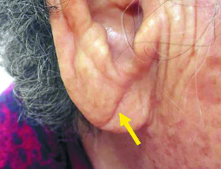 귓불 대각선 주름. /사진=논문 "Diagonal Earlobe Crease is a Visible Sign for Cerebral Small Vessel Disease and Amyloid-β"