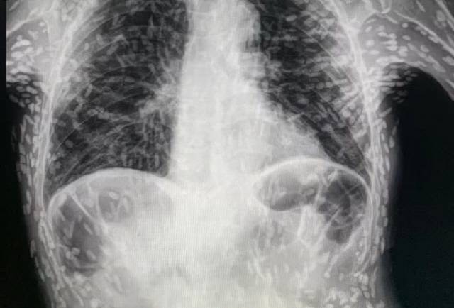 브라질 의료진이 공개한 수백 마리의 석회화된 기생충이 그대로 보이는​ 엑스레이 사진./사진=데일리메일 제공