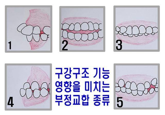 구강구조 기능에 영향을 미칠 수 있는 부정교합의 종류. 1. 상악전돌(측면에서 봤을 때 윗니와 윗턱이 돌출된 경우) 2. 개교(어금니는 맞닿지만 앞니 부분이 맞닿지 않고 벌어져 있는 경우) 3. 과개교합(윗니가 아랫니를 과하게 덮고 있을 경우) 4. 반대교합(측면에서 봤을 때 아랫니와 아래턱이 돌출돼 윗니를 덮을 경우) 5. 총생(치아가 좁은 부위에 뭉쳐서 나고 치아 배열이 부분적으로 넓을 경우). 김민규 기자