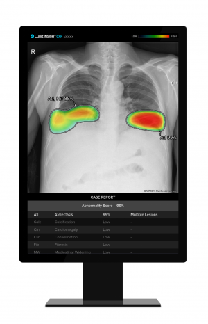 루닛의 흉부 엑스레이 AI 영상분석 솔루션 '루닛 인사이트 CXR'. [사진제공=루닛]