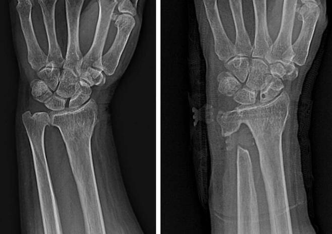A씨 수술 전 방사선 사진(왼쪽)과 수술 1년 후 방사선 사진(오른쪽).