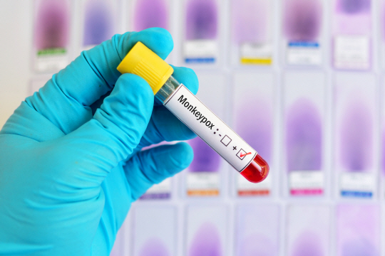 1400639964 Blood sample tube positive with Monkeypox virus, new epidemic disease in 2022
