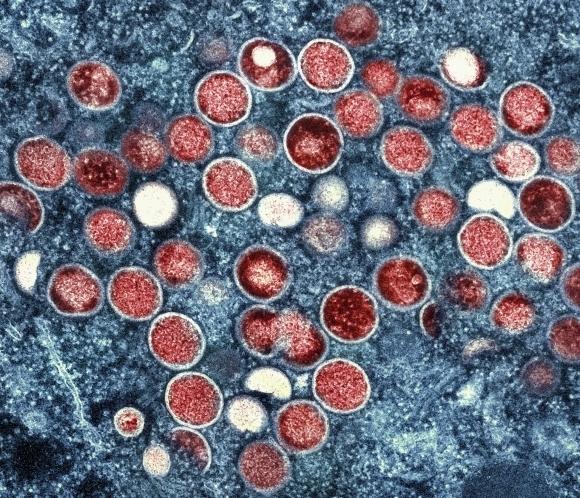미국 국립알레르기감염병연구소(NIAID)가 제공한 엠폭스 이미지. 투과 전자 현미경으로 감염된 세포(파란색) 내 엠폭스 입자(빨간색)가 보이고 있다. 뉴시스