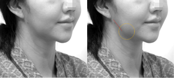 (1) 턱선이 귀밑 부위에서 급히 올라가는 느낌 (빨간 선)​  (2) 아래쪽이 두꺼워지는 느낌 (노란 원)​ [사진=박준규 원장]