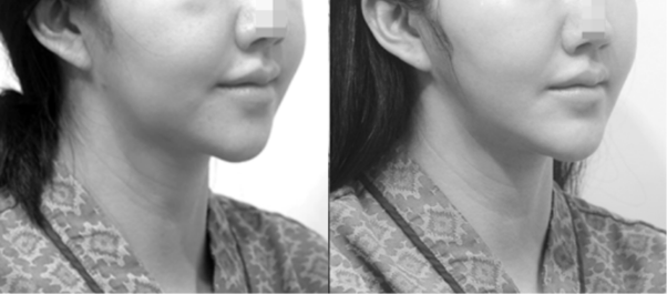 이 경우 원인은 턱끝이 뒤로 빠져 얼굴선이 늘어진 것이므로, 턱끝 위치를 앞으로 잡아주어 얼굴선이 당겨지게 만들어 주었습니다. [사진=박준규 원장]