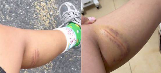 사진=아기사자에게 물린 상처 (출처=hk01)