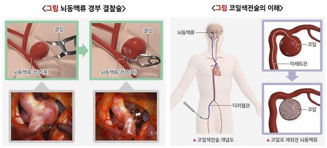 뇌동맥류 결찰술과 코인색전술의 비교.[이미지출처=질병관리청 국가건강정보포털]