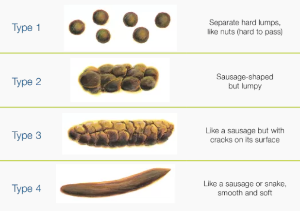 '브리스툴 스툴 스케일' 유형 1~4. / 사진=Continence Foundation of Australia 홈페이지