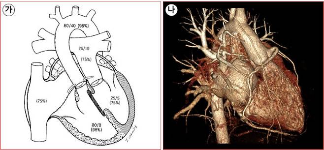 (가) 세닝(Senning) 술식. (나) 세닝 수술 후 CT 소견. [사진2]