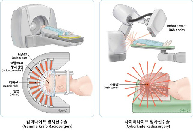 감마나이프 수술(왼쪽 사진)과 사이버나이프 수술 개념도. 국가암정보센터  제공