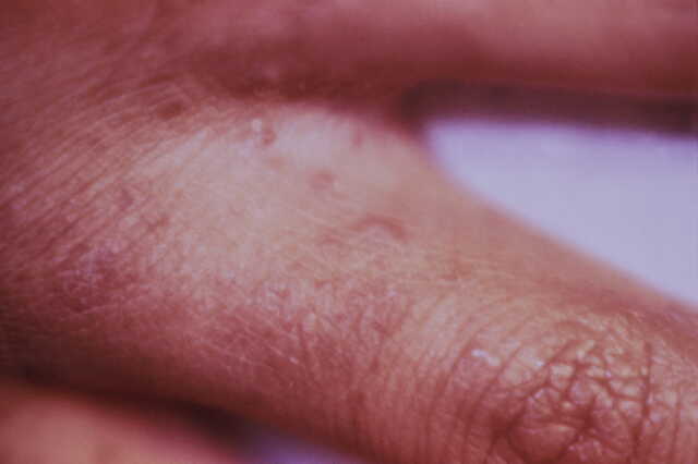 손가락 사이에 발생한 옴진드기 굴 모습. 미국 질병통제예방센터(CDC)