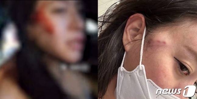 BJ 냠냠짱짱에게 폭행을 당한 BJ 감성여울이 자신의 얼굴에 생긴 포크 자국 상처를 공개했다. (온라인 커뮤니티 갈무리)