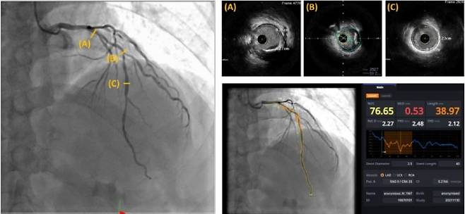 심혈관 조영술 영상(왼쪽) 영상을 바탕으로 인공지능이 각 부위(A~C) 병변의 길이 등을 분석해서 표시(오른쪽 아래)하고 있다.[자료제공=분당서울대병원]