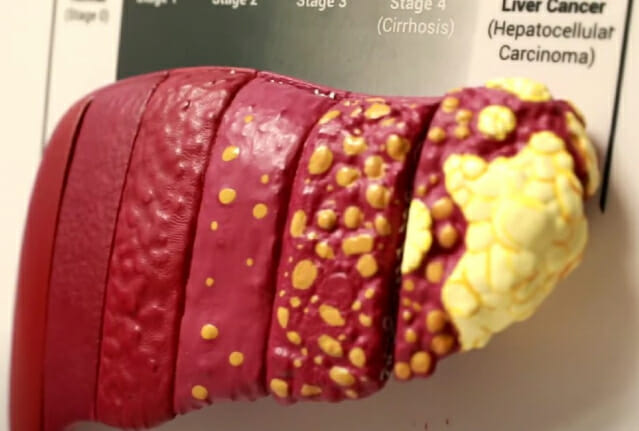 C형간염 이후 간암까지의 발전 모습 (사진=존스홉킨스의대 유튜브 캡처)