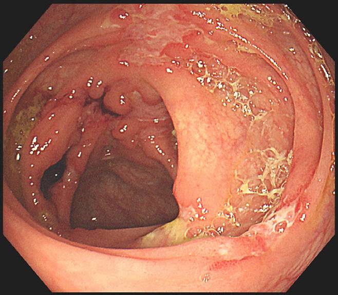 크론병 환자의 대장내시경 모습.