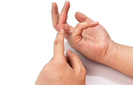 손 습진ㅣ출처: 게티이미지뱅크