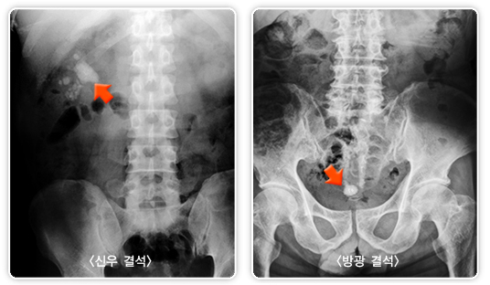 신장 내부에서 형성된 결석(왼쪽)과 방광까지 내려온 결석을 X선으로 촬영한 사진. 보건복지부 제공