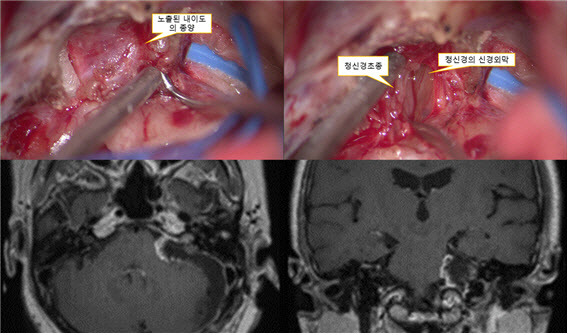 수술 소견 (상부)과 수술 후 뇌MRI (하부).