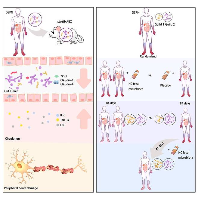 당뇨병성 신경병증 환자의 대변을 당뇨 생쥐에게 이식하면 독성 물질이 나오면서 신경병증 환자처럼 말초신경이 손상됐다(왼쪽). 신경병증 환자에게 건강한 사람의 대변을 이식하면 염증을 막는 장내 세균(노란색)이 늘고 독성 물질을 분비하는 세균(분홍색)은 줄면서 통증이 감소했다(오른쪽). 가짜약을 준 환자는 장내 세균 구성이 달라지지 않았다./Cell Metabolism