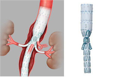 -Branch 스텐트-그라프트 (Zenith, COOK Medical)’.