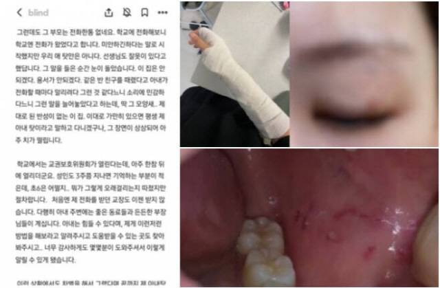 ▲ 난달 30일 서울 양천구 초등학교에서 6학년 학생이 담임 교사를 폭행한 사건이 발생했다. 교사의 남편으로 추정되는 인물은 직장인 익명 커뮤니티 ‘블라인드’에 ‘제 아내가 폭행을 당했습니다’라는 제목의 글을 올렸다. [블라인드·서울교사노동조합]