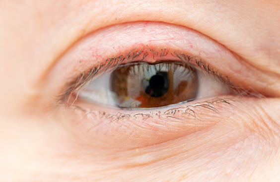 다래끼. /사진=게티이미지뱅크