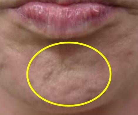 호두턱의 원인은 턱의 중앙 아래쪽에 위치한 턱끝 근육(Mentalis muscle)과 관련 있다./사진=2023년 국제의학전문 학술지 톡신스 논문 "Cosmetic Treatment Using Botulinum Toxin in the Oral and Maxillofacial Area: A Narrative Review of Esthetic Techniques" Cobble Stone Chin