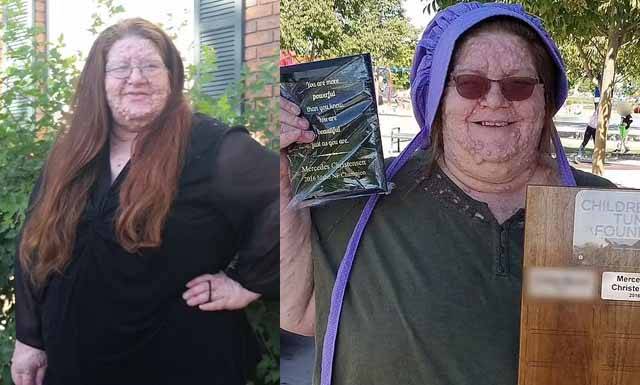 얼굴에 여러 개의 작은 혹을 단순한 수두로 생각했던 52세 여성 메르세데스 크리스텐슨이 신경섬유종증을 진단 받아 화제다./사진=데일리메일