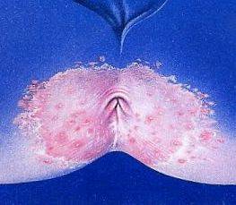 항문과 그 주위 피부가 가려운 소양증 이미지.