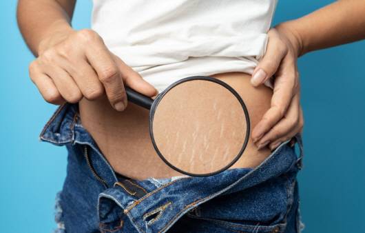 튼살ㅣ출처: 게티이미지뱅크