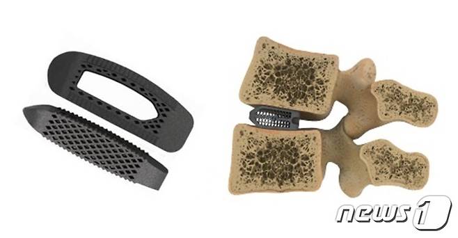 3D프린팅 기술로 제작한 다공성 대형 척추케이지(왼쪽). 다공성 대형 척추케이지를 추간판 자리에 삽입한 모습.(오른쪽) /한림대강남성심병원 제공