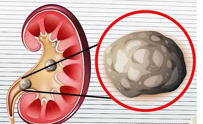 요로결석 서울대병원 제공