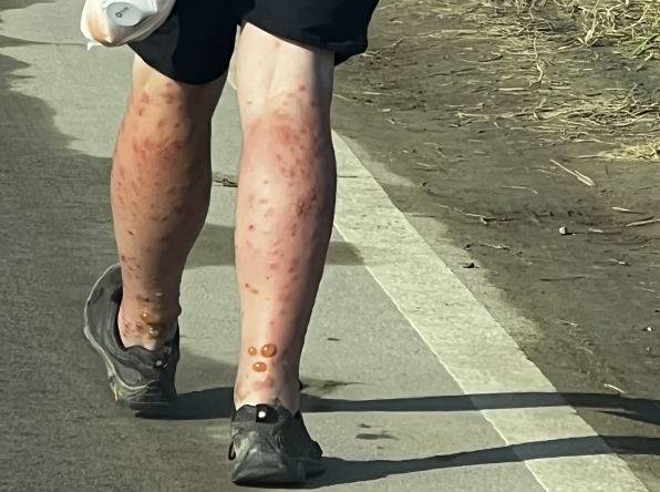 2023 새만금 세계스카우트잼버리에서 부스를 운영하는 한 외국인 참가자의 다리가 벌레에 물려 빨갛게 부풀어 있다. 연합뉴스