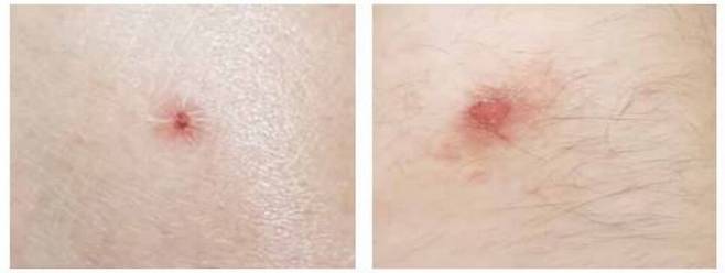 작은소참진드기에 물린 환자의 피부. 충남도 보건환경연구원 제공