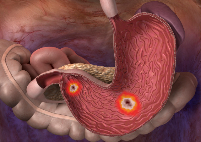우리나라 국민 30%는 위암으로 발전할 수 있는 위축성 위염을 앓고 있다./사진=클립아트코리아
