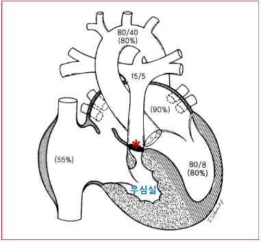 [사진2-1] 폐동맥 폐쇄(별표). 매우 작은 우심실이 관찰됨. 출처:  An Illustrated Guide to Congenital Heart Disease. In Sook Park, Springer Nature 2019.