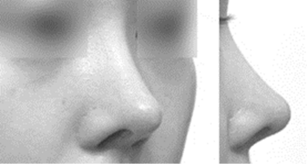 개인적으로는 늑연골로 한껏 높인 이런 코가 도통 예뻐 보이지 않습니다. [사진=박준규 원장]