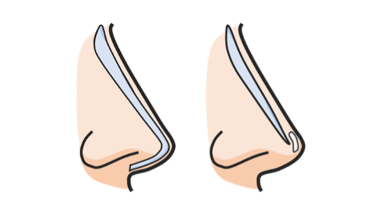 코끝까지 길게 보형물을 쓰면 감염과 염증에 취약합니다. 한때 쓰였던 긴 L자 보형물(왼쪽)은 많은 문제를 일으켜 현재는 시장에서 퇴출된 수준입니다. [그래픽=박준규 원장]
