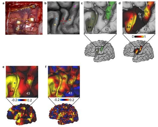 루게릭병 환자 뇌에 삽입된 전극과 그 부위의 fMRI 사진 [Francis R. Willett et al./Nature 캡처. 재판매 및 DB 금지]