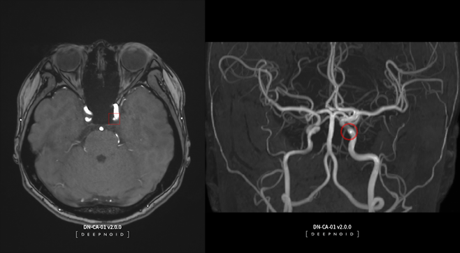 의료용 AI 솔루션인 딥뉴로. 딥뉴로를 활용하면 뇌동맥류 의심 부위를 확인할 수 있다. 사진제공=딥노이드