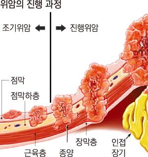 위암 조기검진의 날··· “크기 작은 ‘위점막하종양’도 조기에 잘라낼 필요”