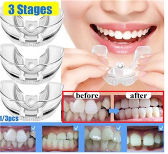 식약처가 불법 사례로 제시한 무허가 셀프 치아교정기 해외직구·구매대행 광고. 식약처 제공