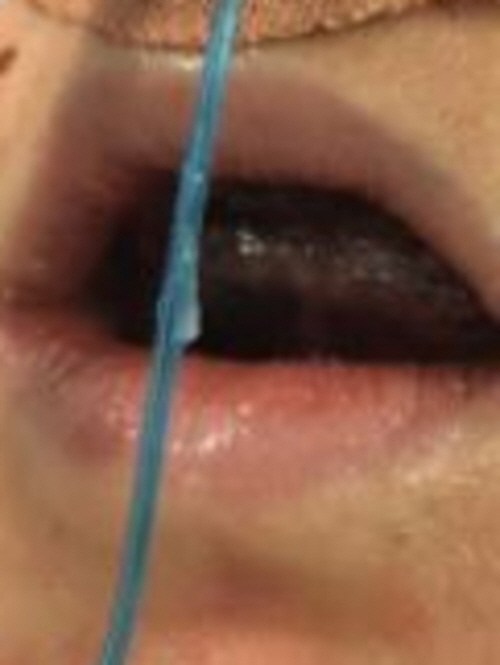 케이티 알솝의 혀가 검은색으로 변한 모습./사진=뉴욕포스트 캡처