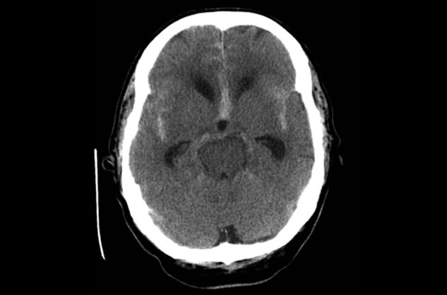 지주막하출혈 컴퓨터단층촬영(CT) 이미지.