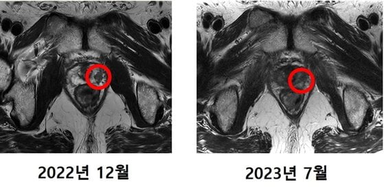 암세포가 사라진 최씨의 MRI 촬영 사진./사진=연세의료원