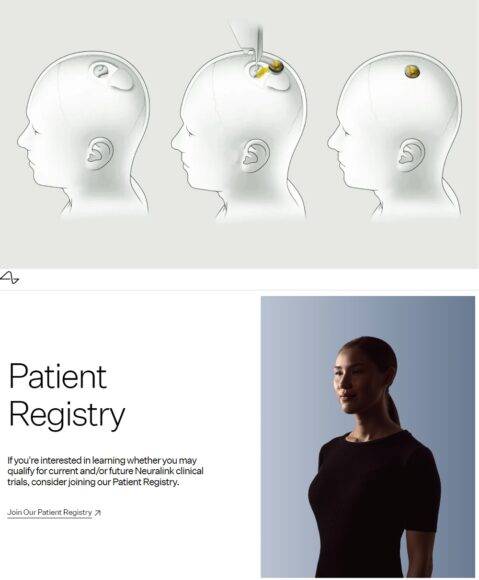 뉴럴링크의 뇌 인터페이스(BCI) 칩 이식 수술 개념도(위)와 홈페이지의 임상시험 참가 모집 공지 내용. [자료=뉴럴링크]