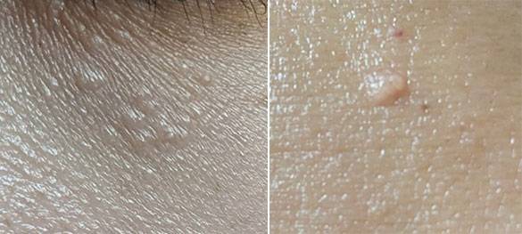 한관종,피지샘증식증/사진=헬스조선DB