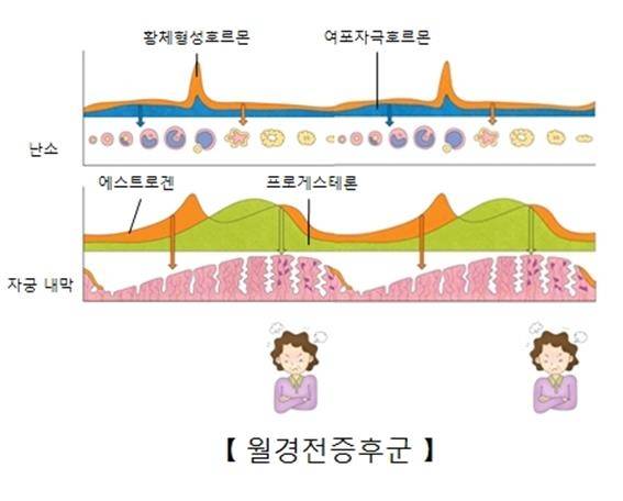 월경전 증후군 [출처: 서울아산병원]